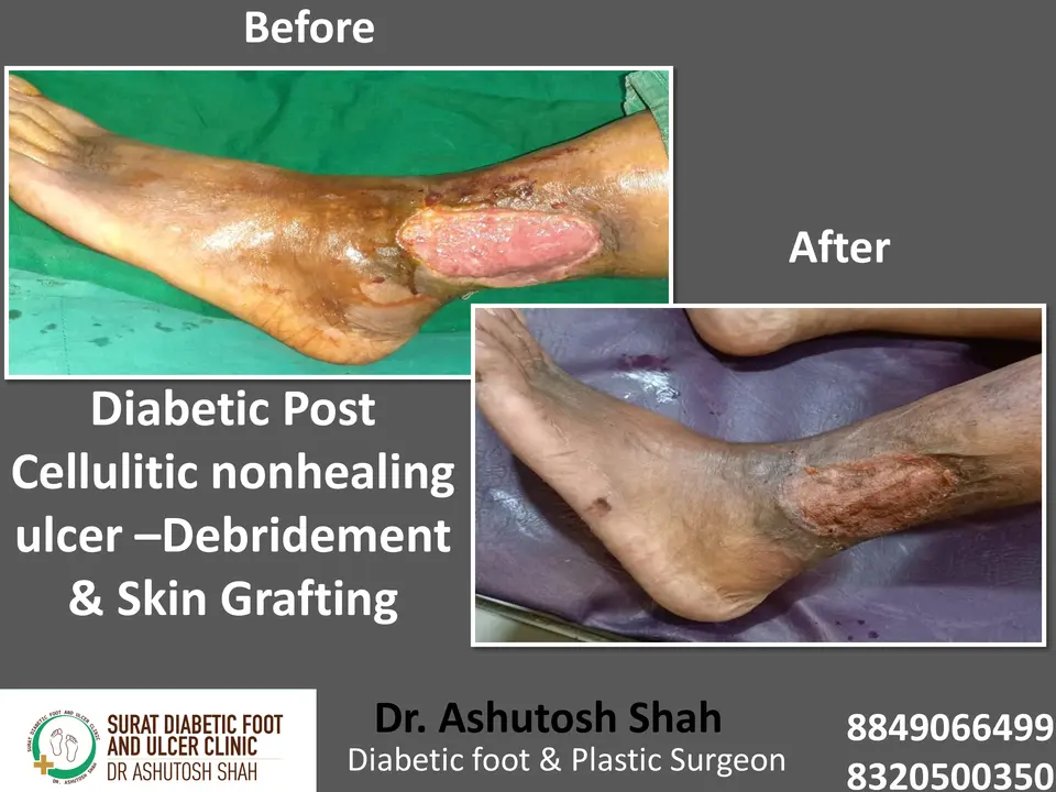 Diabetic Foot  PPT sunita.pptx-47.webp